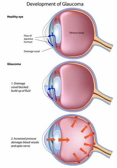 Copyright: alila / 123RF Stock Photo Sketch of glaucoma