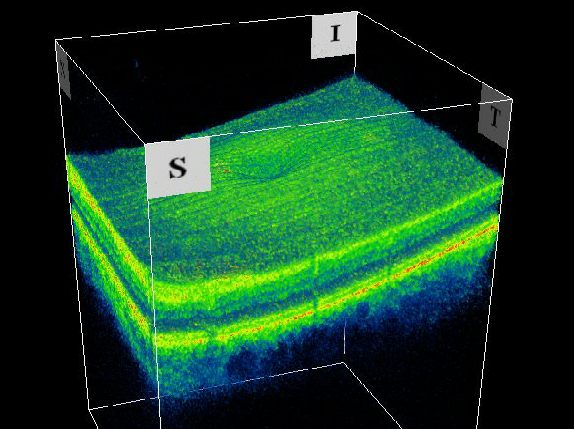 A 3D section of the layers ofthe retina and vitreous jelly A 3D section of the layers ofthe retina and vitreous jelly